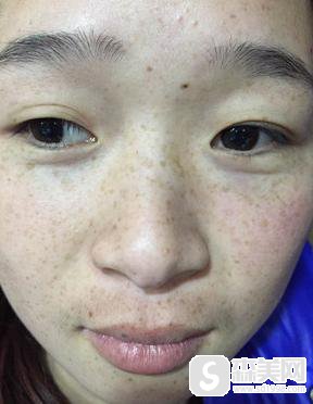 激光祛斑嫩肤手术怎么样？附激光祛斑案例