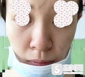 鼻翼过宽缩小整形手术怎么样？附鼻翼缩小手术案例分享