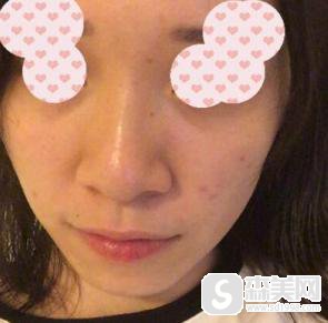 鼻翼过宽缩小整形手术怎么样？附鼻翼缩小手术案例分享