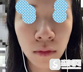 鼻翼过宽缩小整形手术怎么样？附鼻翼缩小手术案例分享