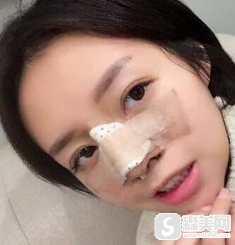 耳软骨垫鼻尖隆鼻手术怎么样?附耳软骨垫鼻尖隆鼻案例分享