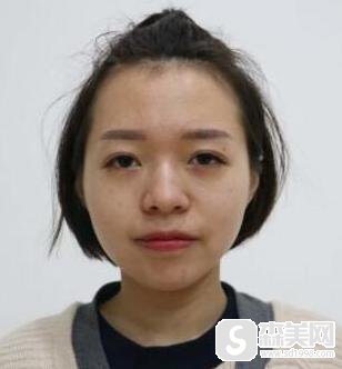 耳软骨垫鼻尖隆鼻手术怎么样?附耳软骨垫鼻尖隆鼻案例分享