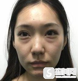 北京八大处整形医院的祛眼袋手术怎么样？附祛眼袋手术案例＋祛眼袋手术前后果对比