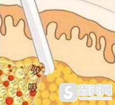 腰部吸脂减肥术的价格以及没问题系数怎么样？附腰部吸脂减肥术前后果图