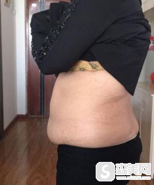 腰部吸脂减肥术的价格以及没问题系数怎么样？附腰部吸脂减肥术前后果图