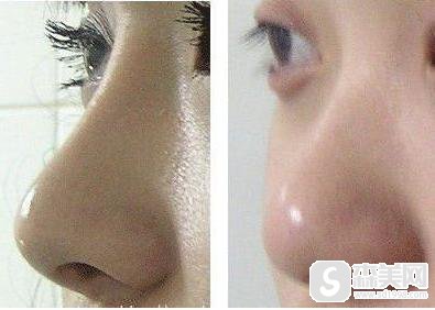 鼻翼缩小术到底是一个什么样的手术?附缩鼻翼案例分享