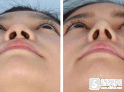 鼻翼缩小术到底是一个什么样的手术?附缩鼻翼案例分享