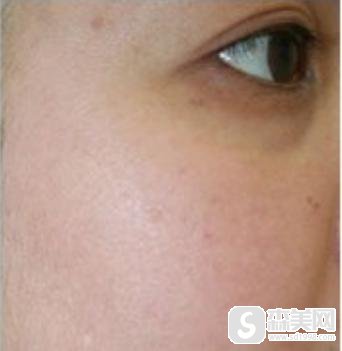 飞顿嫩肤激光祛斑果是什么样子的?附飞顿激光祛斑案例分享