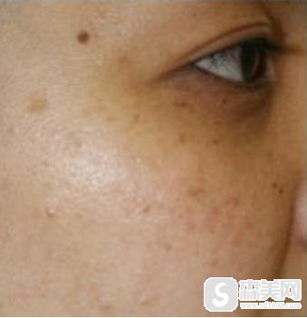 飞顿嫩肤激光祛斑果是什么样子的?附飞顿激光祛斑案例分享