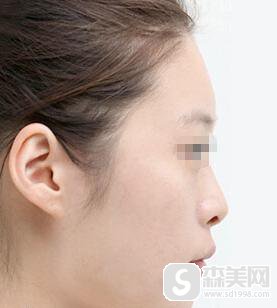 硅胶垫鼻果怎么样？有什么优势？附硅胶垫鼻案例分享＋手术前后果对比图