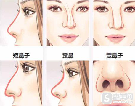 硅胶垫鼻果怎么样？有什么优势？附硅胶垫鼻案例分享＋手术前后果对比图