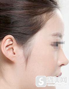 硅胶垫鼻果怎么样？有什么优势？附硅胶垫鼻案例分享＋手术前后果对比图
