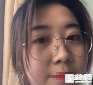 脸部吸脂全过程曝光,附脸部吸脂案例前后果对比图