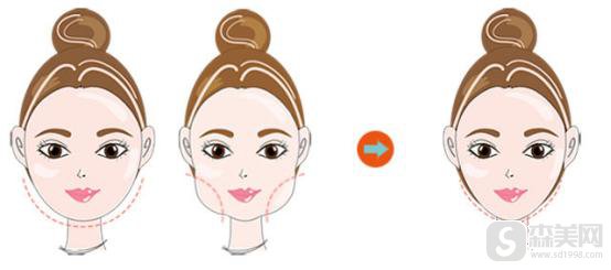 脸部吸脂全过程曝光,附脸部吸脂案例前后果对比图