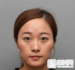 2021整形价格表曝光,附真实双眼皮案例分享!