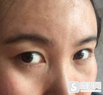 北京东方和谐整形医院祛眼袋手术怎么样？附祛眼袋案例分享