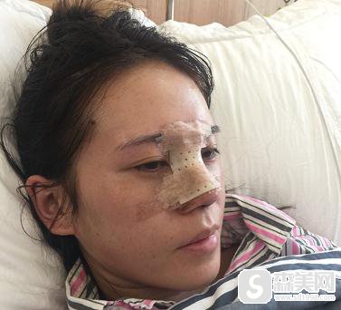 陈宇个人简介,口碑好不好?附重庆美莱隆鼻案例分享