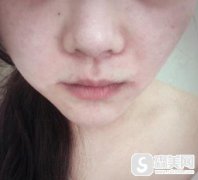 深圳北大医院鼻头鼻翼缩小价格，附案例前后展示