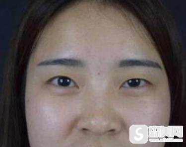 重庆当代开扇形双眼皮怎么样?附90天详情