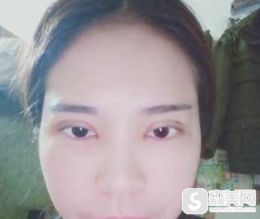 重庆当代开扇形双眼皮怎么样?附90天详情