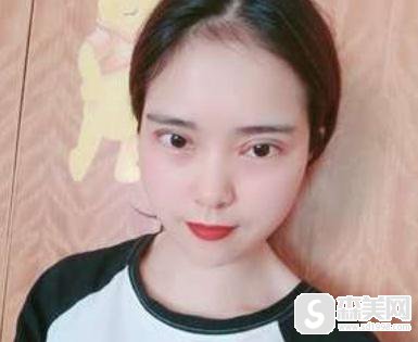 重庆当代开扇形双眼皮怎么样?附90天详情