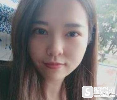 重庆当代开扇形双眼皮怎么样?附90天详情