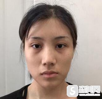 上海九院鼻孔缩小术,附隆鼻恢复详情以及分析