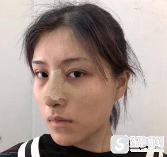 上海九院鼻孔缩小术,附隆鼻恢复详情以及分析