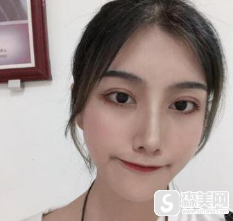 上海九院鼻孔缩小术,附隆鼻恢复详情以及分析