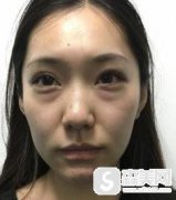 重庆华美吸脂去下眼睑眼袋案例，附前后对比照片