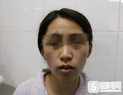 额头填充术怎么样？额头填充术原理解析及真实手术案例分享！