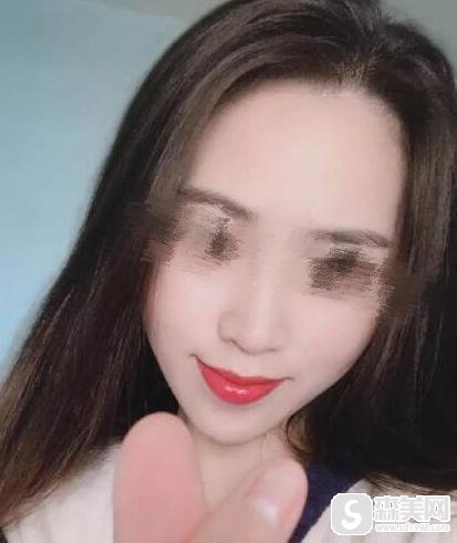 额头填充术怎么样？额头填充术原理解析及真实手术案例分享！