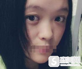 西安西京医院的隆鼻手术恢复果怎么样?附隆鼻手术过程+隆鼻手术前后果对比图