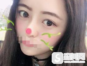 西安西京医院的隆鼻手术恢复果怎么样?附隆鼻手术过程+隆鼻手术前后果对比图
