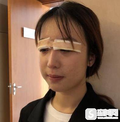 内双割双眼皮手术怎么样？附内双割双眼皮真实案例分享！