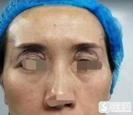 面部凹陷填充手术怎么样?附面部填充案例分享