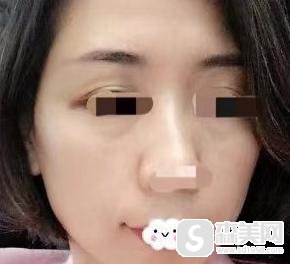 面部凹陷填充手术怎么样?附面部填充案例分享