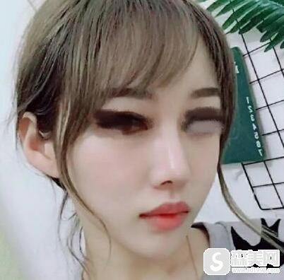 垫鼻子手术疼不疼？附隆鼻案例分享+前后对比照