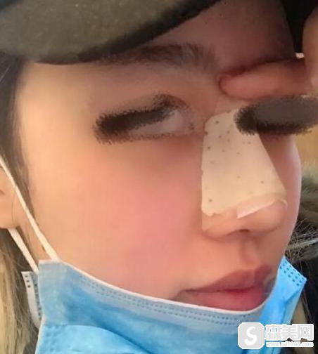 垫鼻子手术疼不疼？附隆鼻案例分享+前后对比照