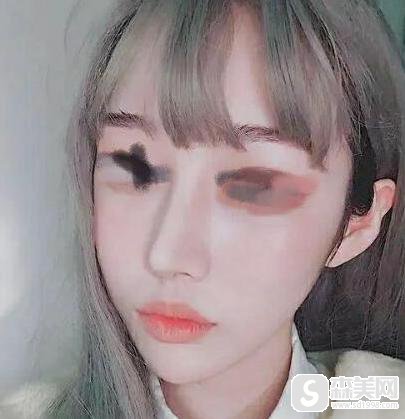 垫鼻子手术疼不疼？附隆鼻案例分享+前后对比照