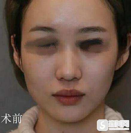 垫鼻子手术疼不疼？附隆鼻案例分享+前后对比照