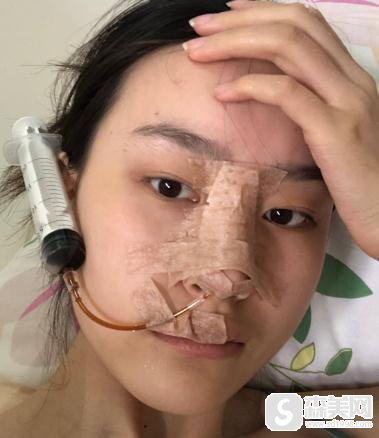 北京八大处鼻翼大整形，附案例恢复日记