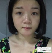 南宁韩成打注射瘦脸前后果图对比,附真人案例的展示