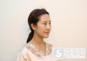 中国人民解放军总医院面部填充案例,附70天恢复详情