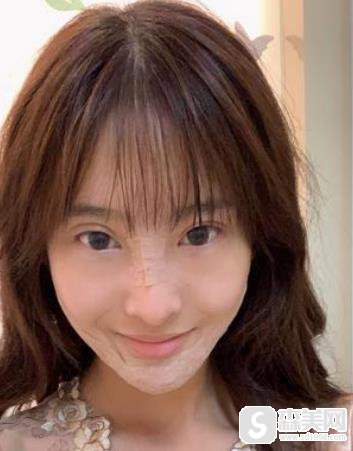 中国人民解放军总医院面部填充案例,附70天恢复详情