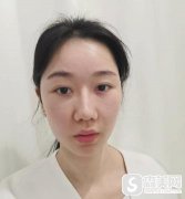 重庆华美玻尿酸注射隆鼻方法？附案例分享+华美2021年较新价格表