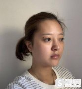苏州圣爱注射瘦脸瘦咬肌多少钱，附案例恢复详情+2021项目价格表