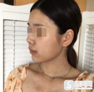 上海时光激光去除黄褐斑案例，附前后对比图+激光治疗全解