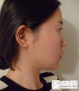 成都西区韩式鼻尖整形,附90天恢复详情+隆鼻具体恢复时间