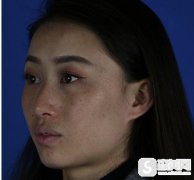 北京美莱激光美容祛斑价钱，附案例对比照片+2021较新价格表